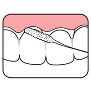 TePe Bridge & Implant Floss Зъбен конец с гъбеста секция, подходящ за почистване на импланти и мостове 30 бр TePe Bridge & Implant Floss Зъбен конец с гъбеста секция, подходящ за почистване на импланти и мостове 30 бр
