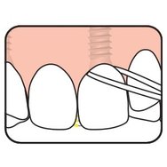 TePe Bridge & Implant Floss Зъбен конец с гъбеста секция, подходящ за почистване на импланти и мостове 30 бр TePe Bridge & Implant Floss Зъбен конец с гъбеста секция, подходящ за почистване на импланти и мостове 30 бр