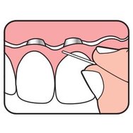 TePe Bridge & Implant Floss Зъбен конец с гъбеста секция, подходящ за почистване на импланти и мостове 30 бр TePe Bridge & Implant Floss Зъбен конец с гъбеста секция, подходящ за почистване на импланти и мостове 30 бр