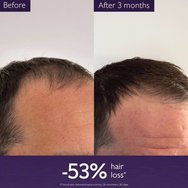 Caudalie Anti-Hair Loss Serum Серум за слаба, тънка коса, против реактивен косопад, свързан със стрес, сезонни промени, раждане 50ml Caudalie Anti-Hair Loss Serum Серум за слаба, тънка коса, против реактивен косопад, свързан със стрес, сезонни промени, раждане 50ml